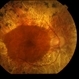 Macula Spared Advanced Retinitis Pigmentosa 7 Macula Spared Advanced Retinitis Pigmentosa 7